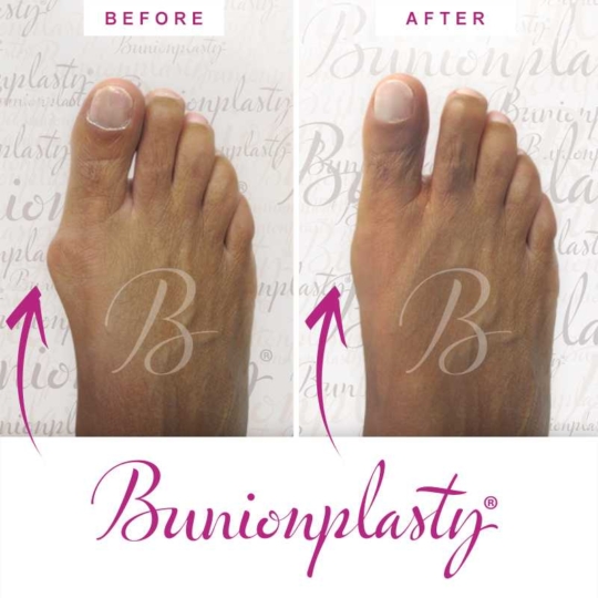 Bunionplasty Before & After Patient 1