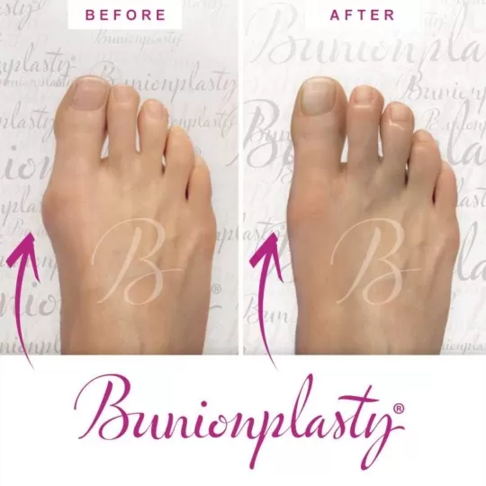 Bunionplasty Before & After Patient 2