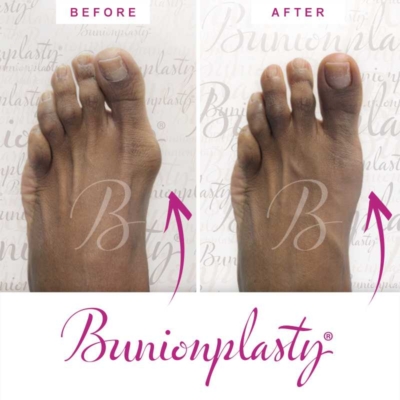 Bunionplasty Before & After Patient 3