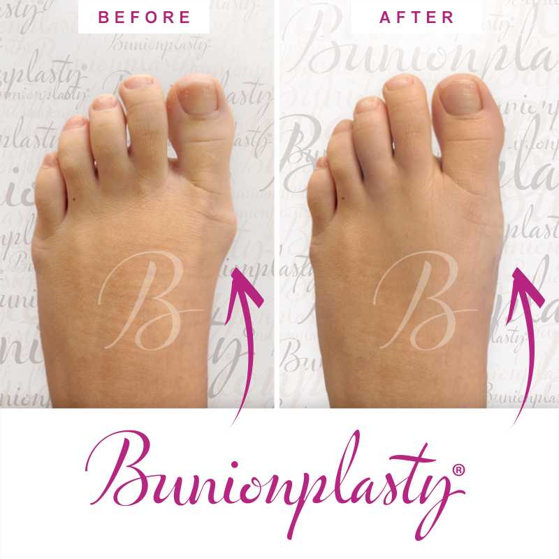 Bunionplasty Before & After Patient 4