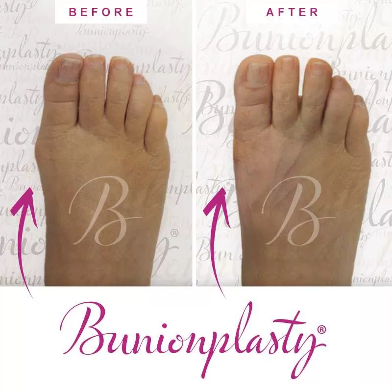 Bunionplasty Before & After Patient 5