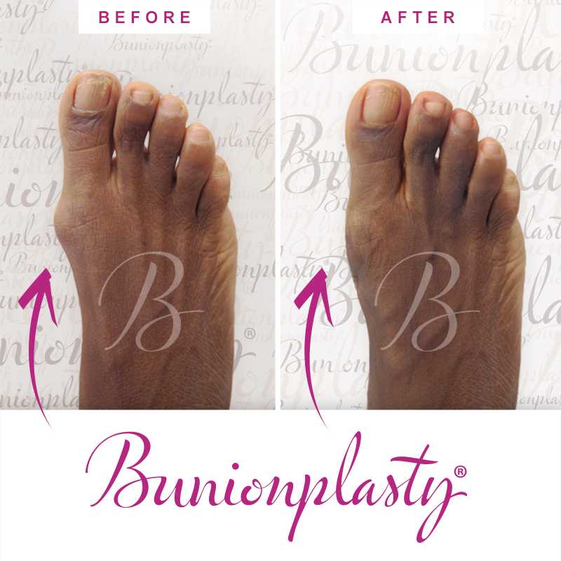 Bunionplasty Before & After Patient 6