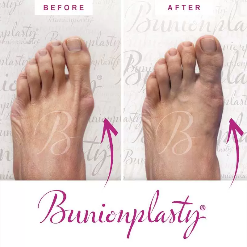 Bunionplasty Before & After Patient 7