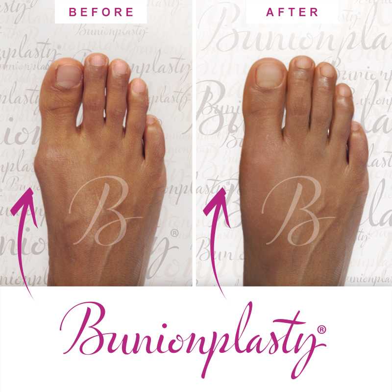 Bunionplasty Before & After Patient 8