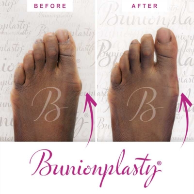 Bunionplasty Before & After Patient 16