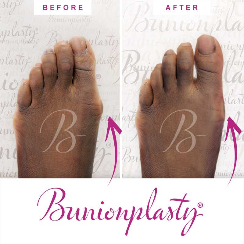 Bunionplasty Before & After Patient 10