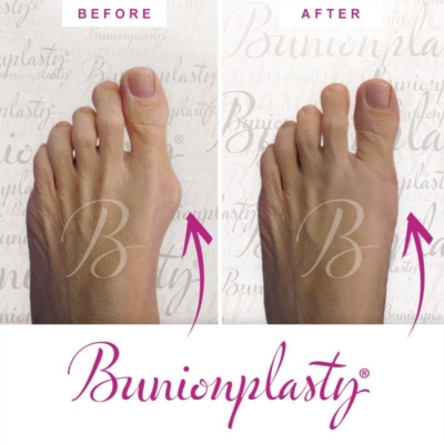 Bunionplasty Before & After Patient 17