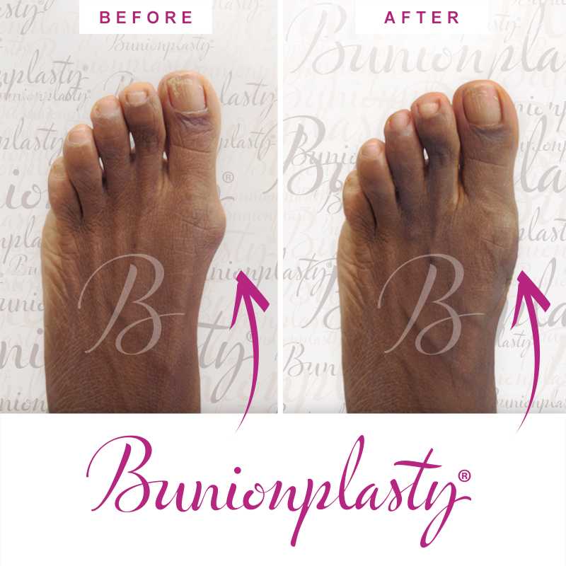 Bunionplasty Before & After Patient 12
