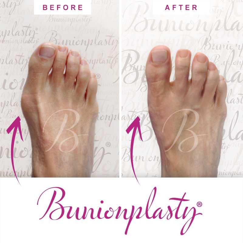 Bunionplasty Before & After Patient 19