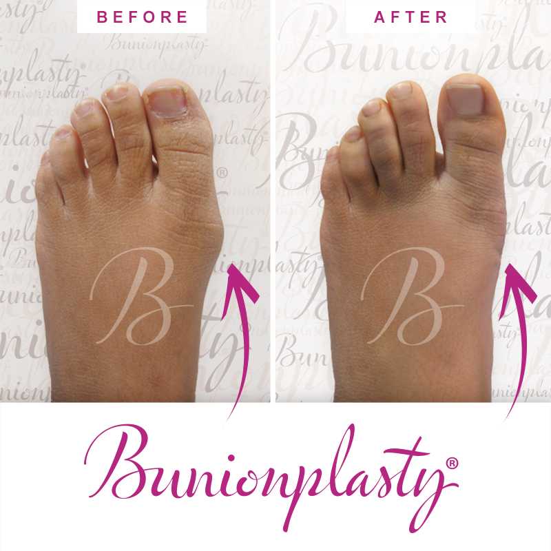 Bunionplasty Before & After Patient 14