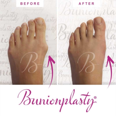 Bunionplasty Before & After Patient 21