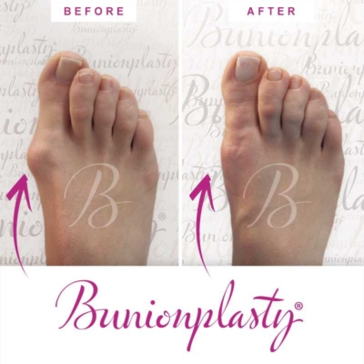 Bunionplasty Before & After Patient 22