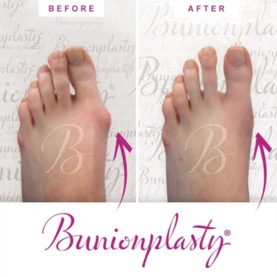 Bunionplasty Before & After Patient 23