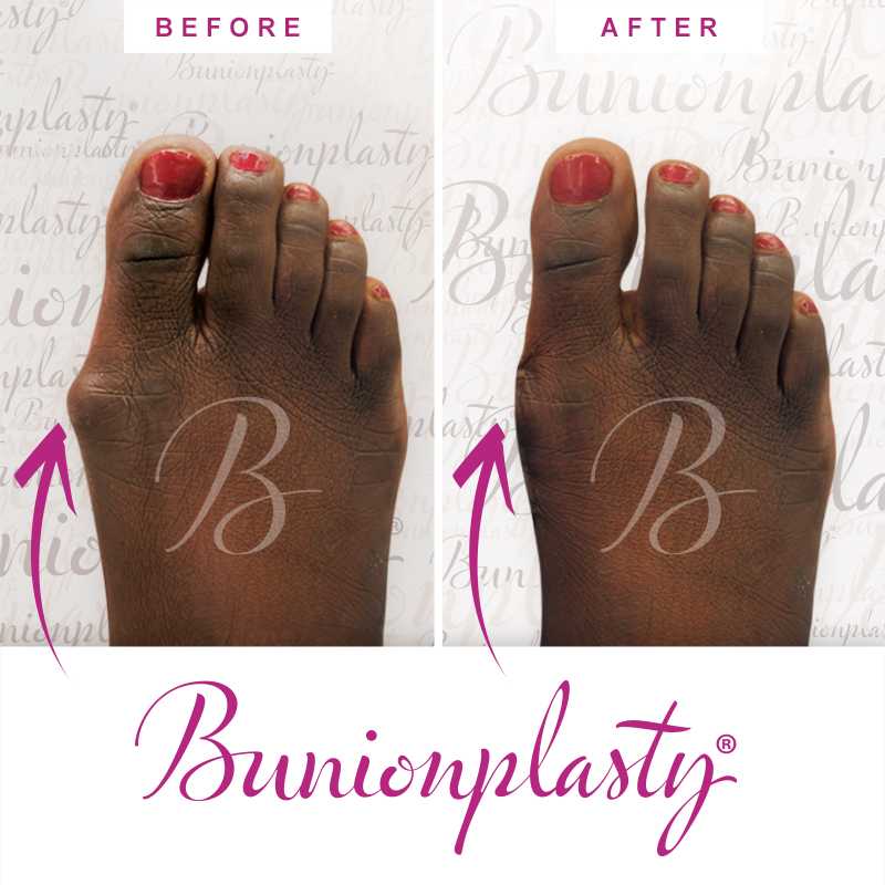 Bunionplasty Before & After Patient 24