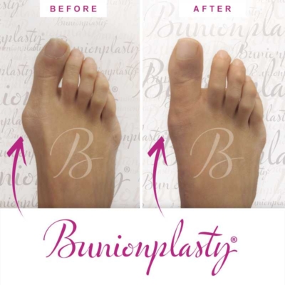 Bunionplasty Before & After Patient 25
