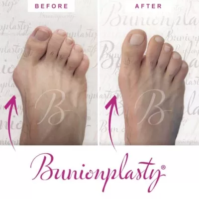 Bunionplasty Before & After Patient 26