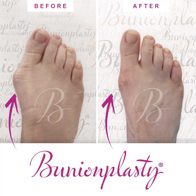 Bunionplasty Before & After Patient 27