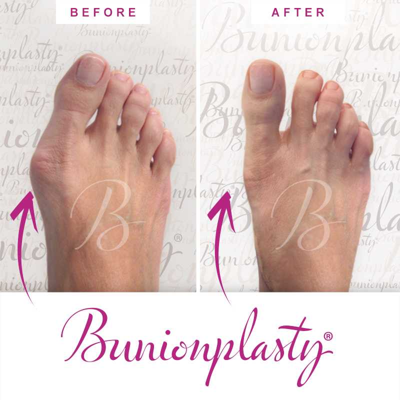 Bunionplasty Before & After Patient 28