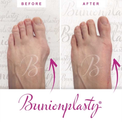 Bunionplasty Before & After Patient 29
