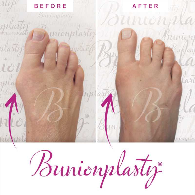 Bunionplasty Before & After Patient 30