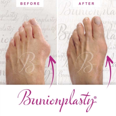 Bunionplasty Before & After Patient 31