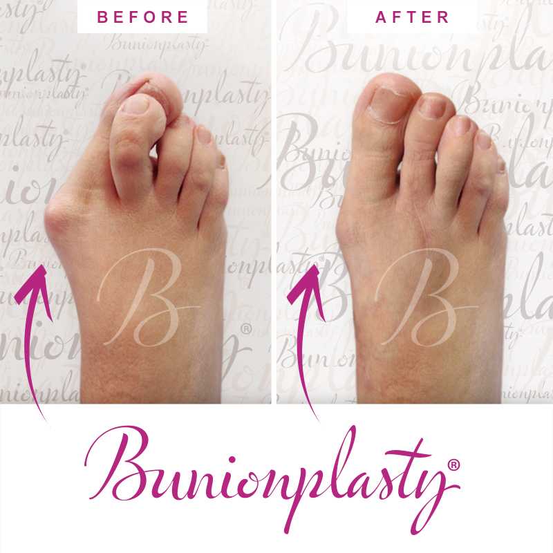 Bunionplasty Before & After Patient 32
