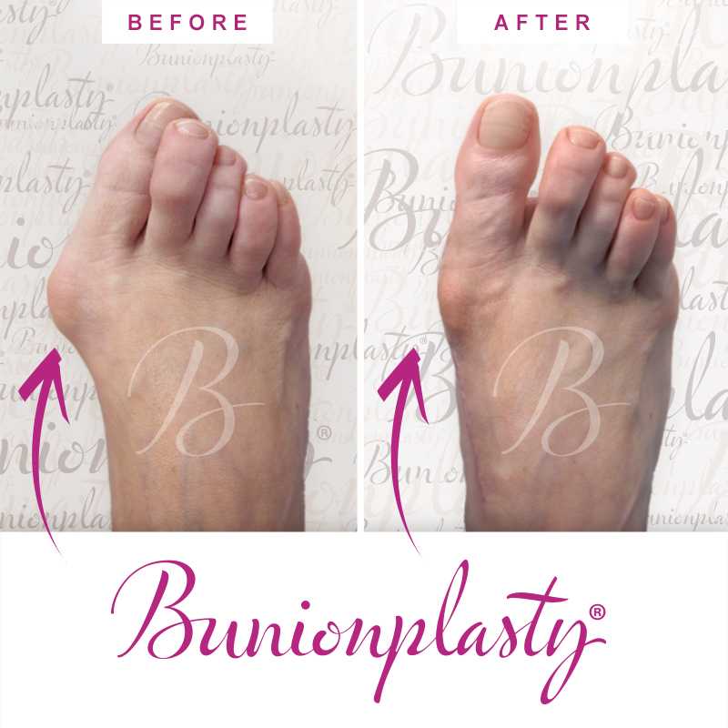 Bunionplasty Before & After Patient 33