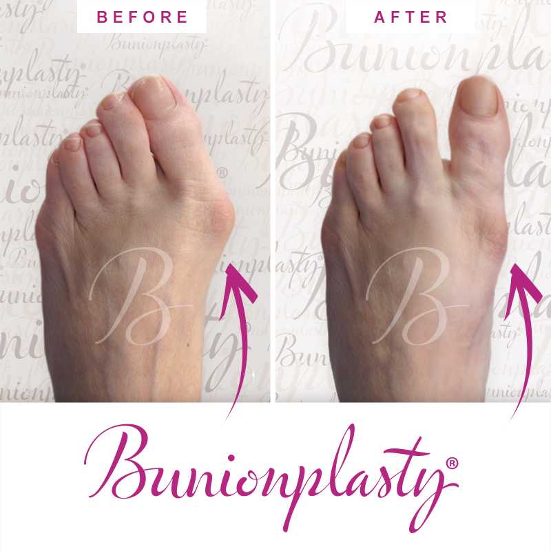 Bunionplasty Before & After Patient 34
