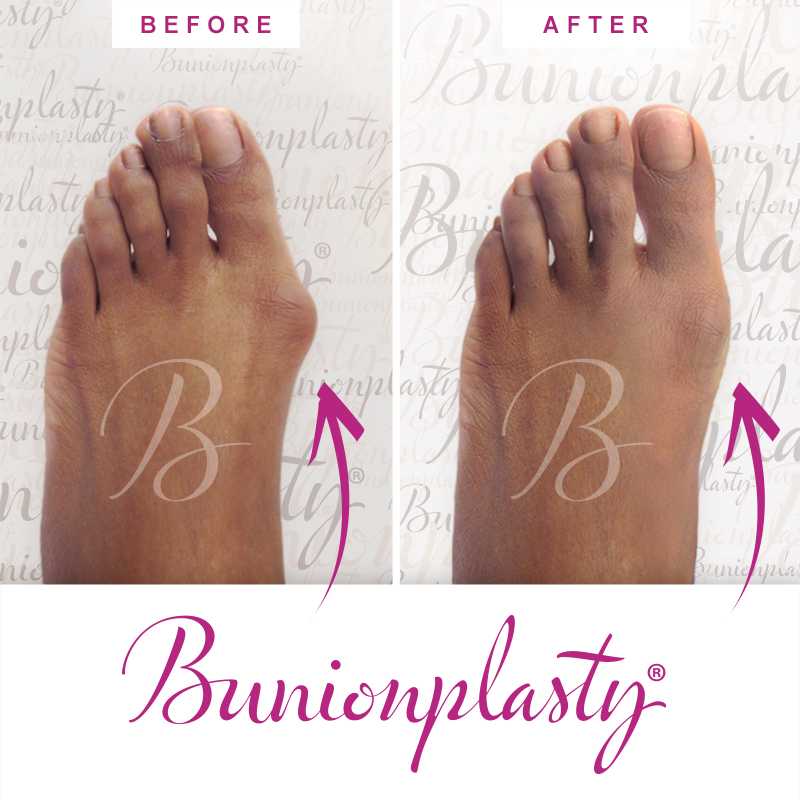 Bunionplasty Before & After Patient 35
