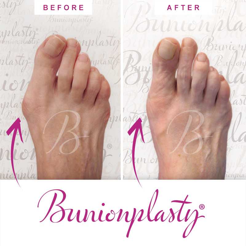 Bunionplasty Before & After Patient 36