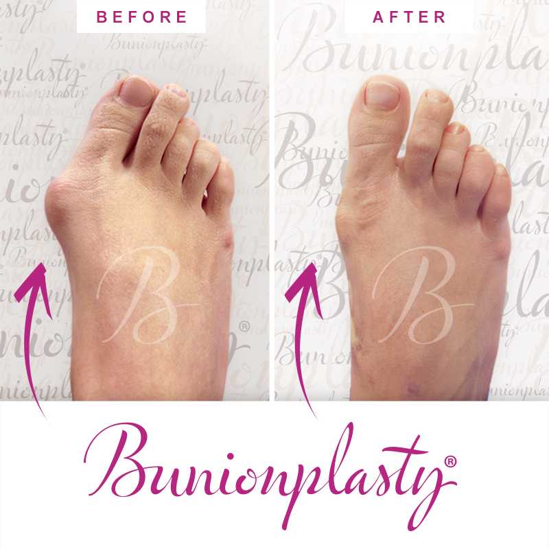Bunionplasty Before & After Patient 37