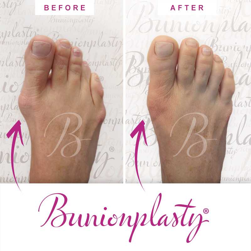 Bunionplasty Before & After Patient 38
