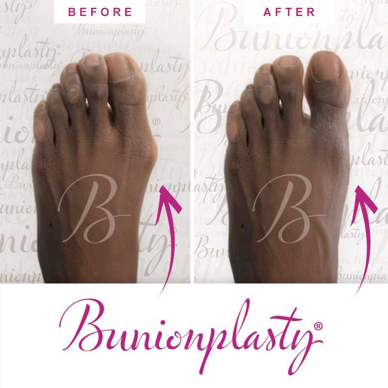 Bunionplasty Before & After Patient 40