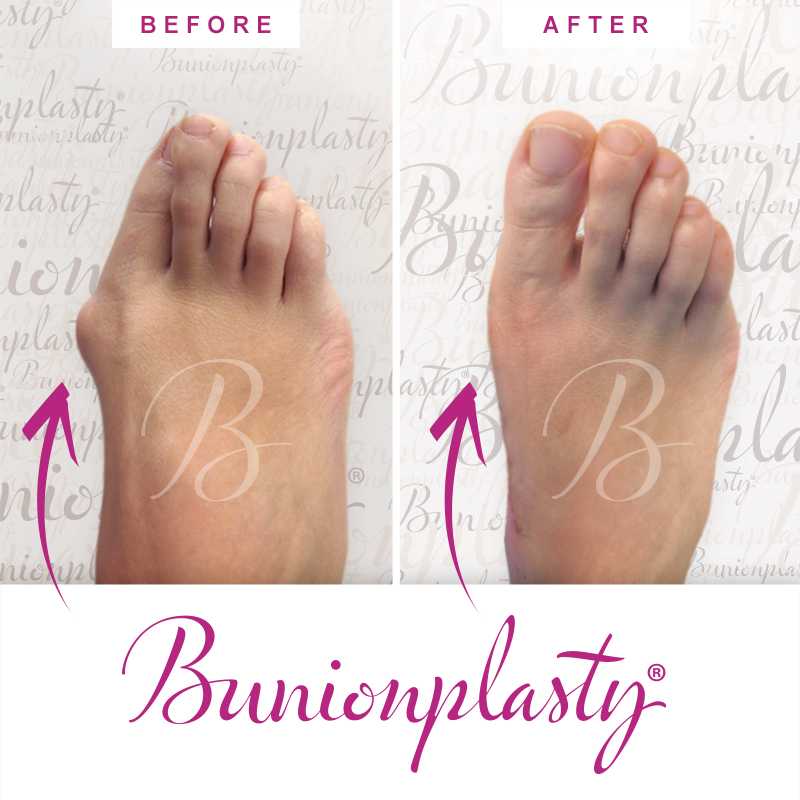 Bunionplasty Before & After Patient 41