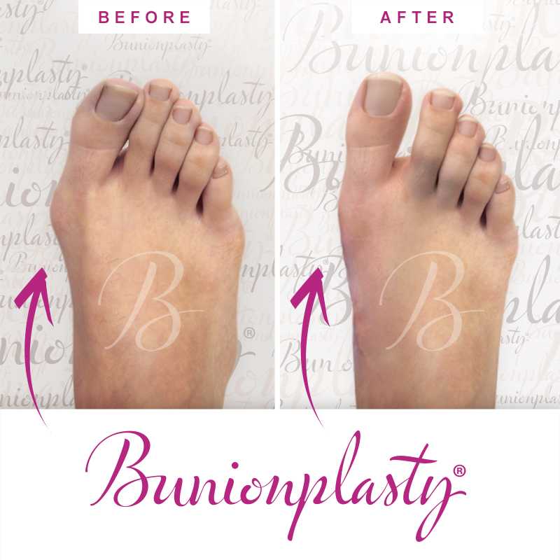 Bunionplasty Before & After Patient 43