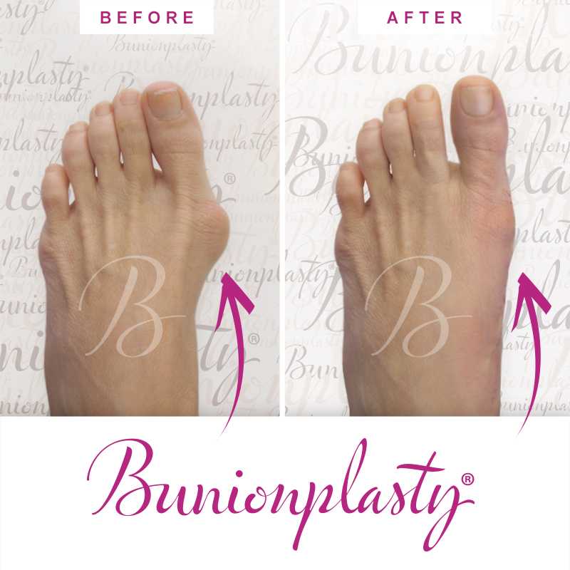 Bunionplasty Before & After Patient 44