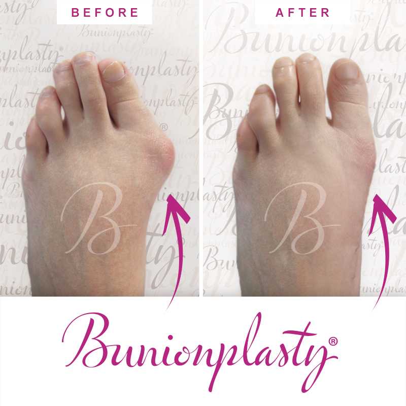 Bunionplasty Before & After Patient 45