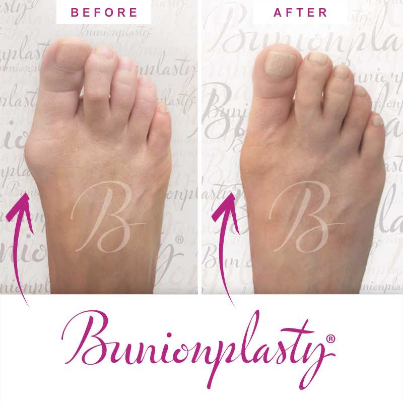 Bunionplasty Before & After Patient 46