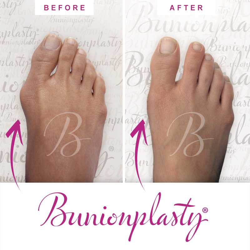 Bunionplasty Before & After Patient 47