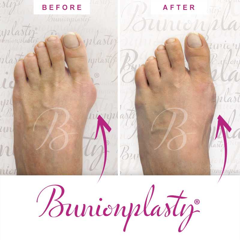 Bunionplasty Before & After Patient 48