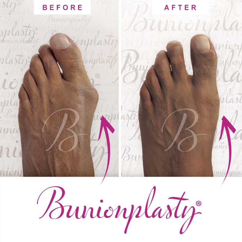 Bunionplasty Before & After Patient 49