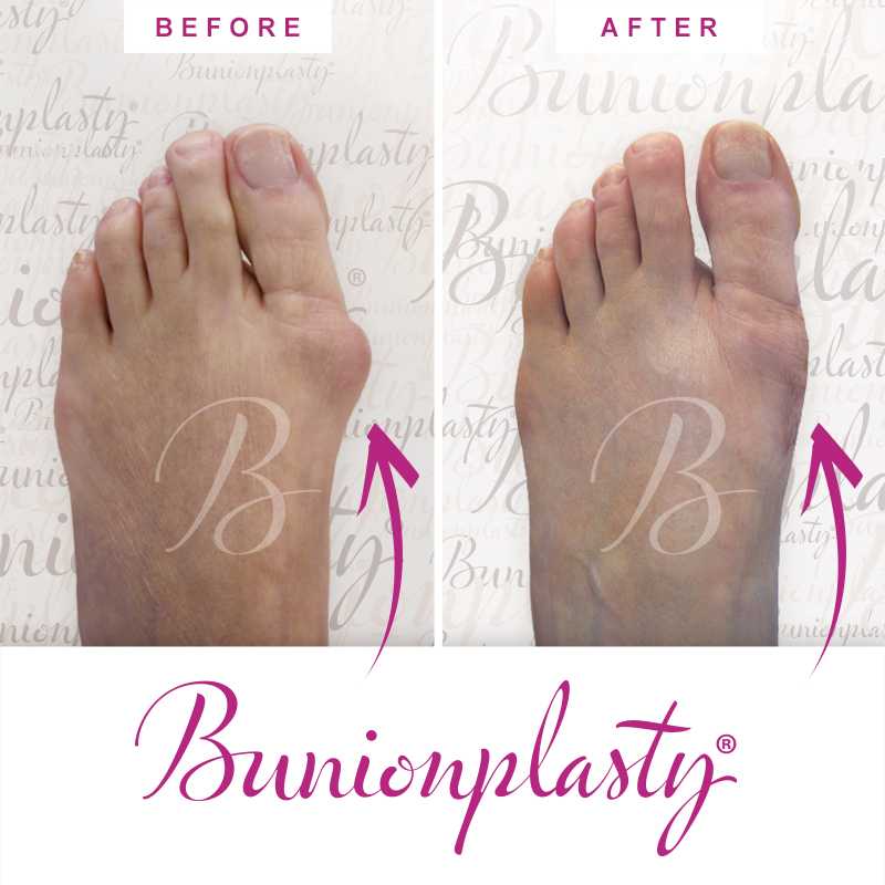 Bunionplasty Before & After Patient 50