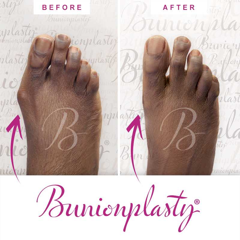Bunionplasty Before & After Patient 51