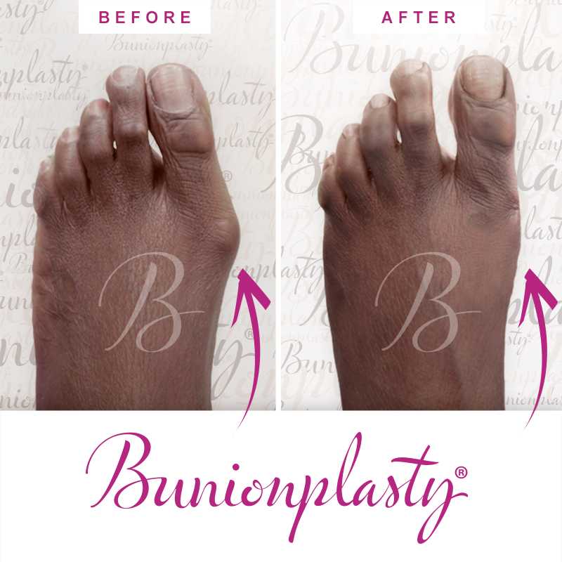 Bunionplasty Before & After Patient 52