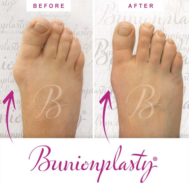 Bunionplasty Before & After Patient 53