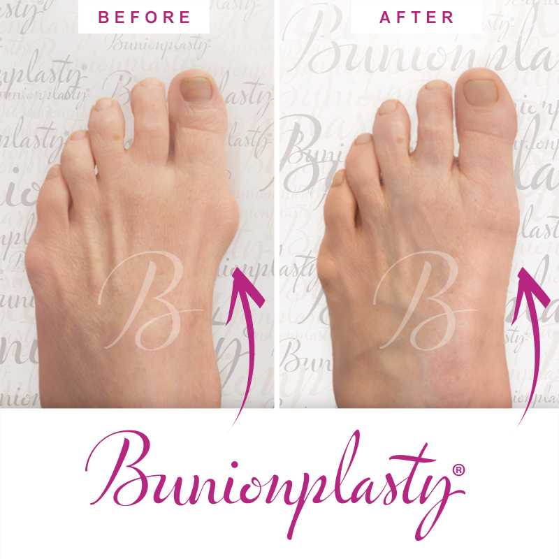 Bunionplasty Before & After Patient 54