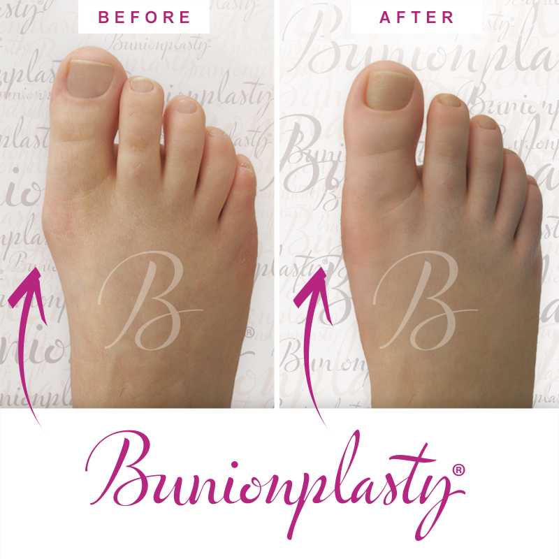 Bunionplasty Before & After Patient 55