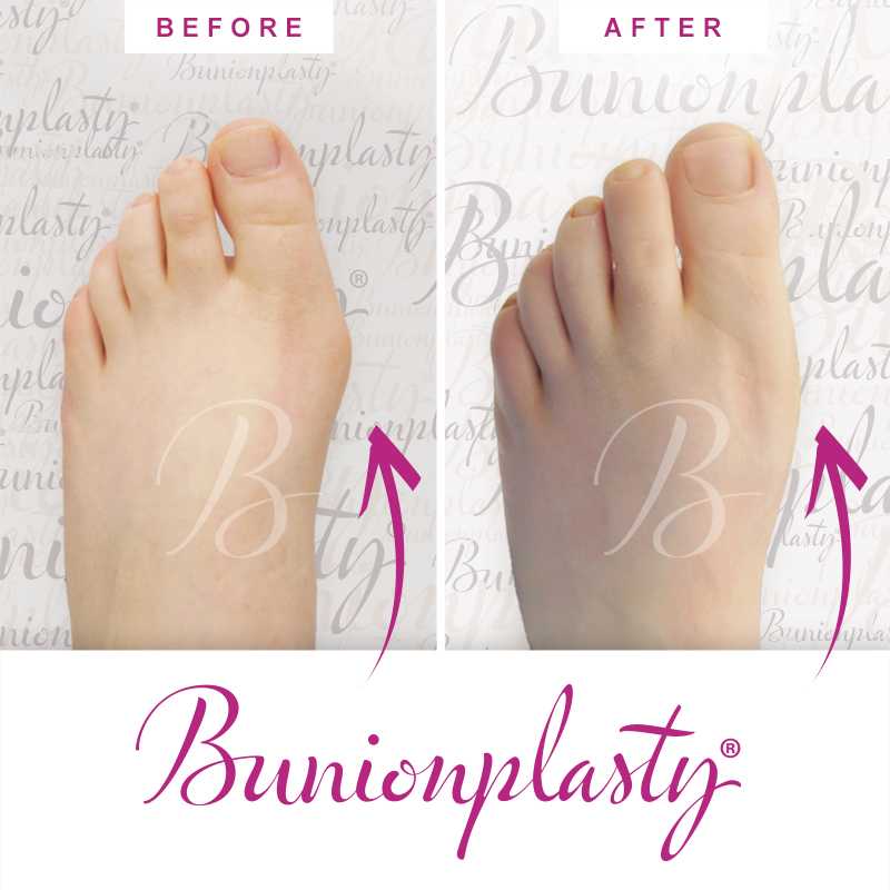Bunionplasty Before & After Patient 56