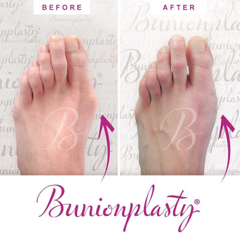 Bunionplasty Before & After Patient 57