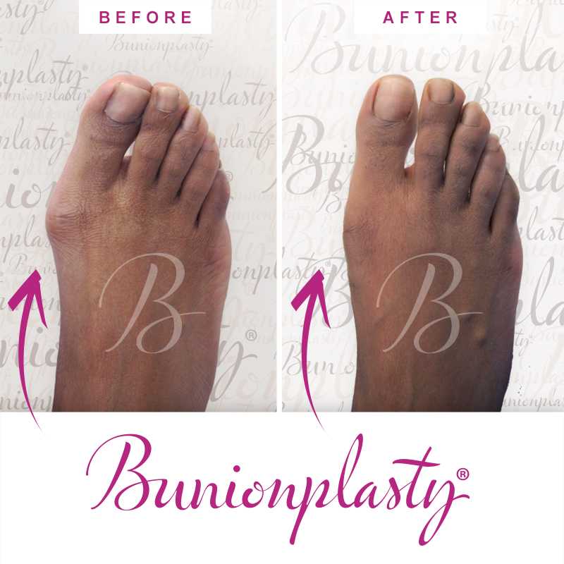 Bunionplasty Before & After Patient 58